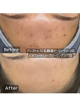 エルエーズ(Elleaise)/肌質改善が得意なサロン