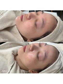 イロハ(IROHA)/幹細胞ピーリング×プラズマ