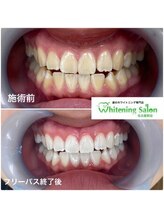 ホワイトニングサロン 名古屋駅店/【ホワイトニング施術例】