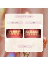 プラスビーセルフ(+b self)/ホワイトニングビフォーアフター