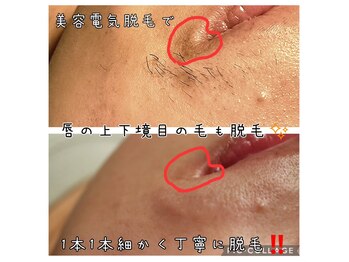 ベビースキン(baby skin)/美容電気脱毛