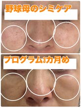 ジュエルビューティー(Jewel Beauty)/　肌改善プログラムリセラADS