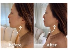 ミラ(mira)の雰囲気(たるみ・フェイスラインの救世主!国家資格保持)