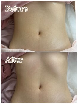 オン 絹(on silk)/腸もみ/1回/オプション