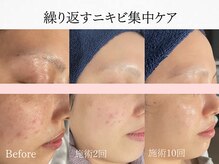 アンドミルル(and Milulu)/【繰り返すニキビ集中ケア】