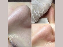 セリジェ 青山(Cerisier)/詰まったままだと開き毛穴に！