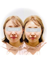 ワカヤマ 小顔(Wakayama)/☆Before・After☆