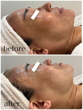 プライベートサロン ラ ペーシュ/くすみとり&引締めが叶います♪