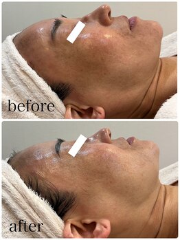 プライベートサロン ラ ペーシュ/くすみとり&引締めが叶います♪