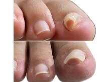 器具なし初日に、辛い感覚がなくなる方多数！当日駆け込み◎