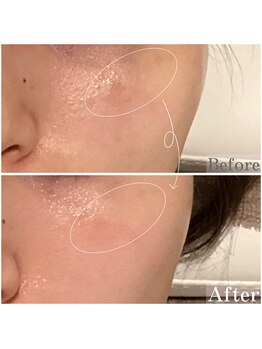 ドクターエイチ 麻布十番店(Doctor.H)/無針水光注入・回数券