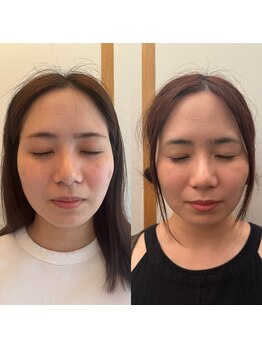 イロドリ 南浦和(irodori)/小顔矯正