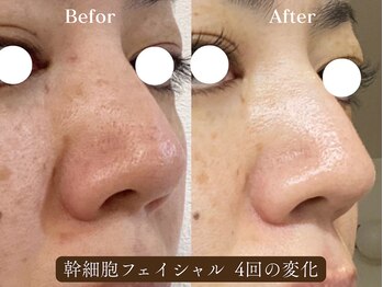 サロン アイプラス(salon i plus)の写真/くすみを改善し、お肌のトーンアップ、ハリ艶をもたらせ、透明感のあるお肌へと導きます。