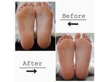 角質つるつる　フルケアコース