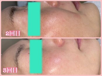 ララン(Laran)/フェイシャル