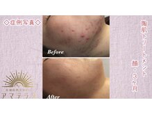 アマテラス 原宿店の雰囲気（ハーブピーリング【ニキビ/毛穴/小鼻黒ずみ】）