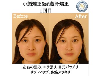 RKY/小顔矯正&頭蓋骨矯正 1回目