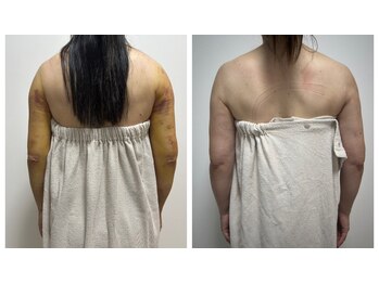 オンケイ(Onkei)/ダウンタイムケア5回