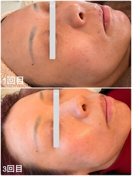 美バストアルファ(美bust α)/【シミケア】症例