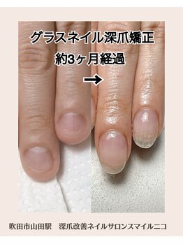 グラスネイル深爪矯正