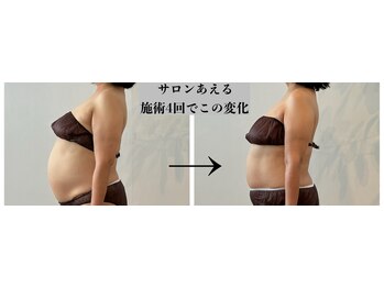 サロンあえる 新大宮店/施術4回でこの変化