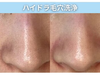 BUB 立川/黒ずみバイバイ