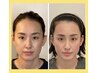 人気No. 1【面長矯正】~メスを使用せず骨格を変える美容施術~当サロン考案