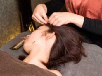 カリスタ 広島店(CALISTA)の写真/本格美容鍼で小顔ケア。リンパの流れを良くし、老廃物の排出を促進＆スッキリした小顔を目指します。