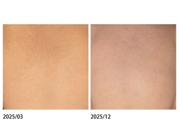 オーシャンブルー 佐世保店(OCEAN BLUE)/結果の出る脱毛【背中】