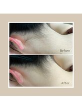 ボーテ ドゥ ランジュ(BEAUTE DE L’ANGE.)/◆うなじ脱毛◆