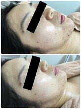 メイユール(MEILLEUR)/光フェイシャル1回