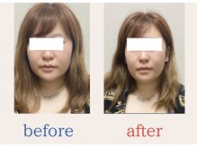 タケダ整体院/小顔矯正before/after ２