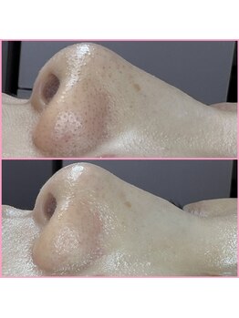 プラスボーテ 幡ヶ谷(plus beaute)/毛穴洗浄/施術前後