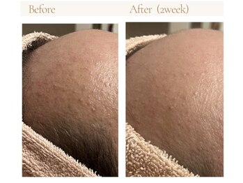 プリズミント(Prismint)/ニキビケア