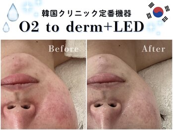 ヘティ バイ ソウル 中目黒(HETIY by Seoul)/O2 to Derm◇施術1回目