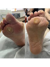 コトリ(Kotori)/【タコ・魚の目ケア】