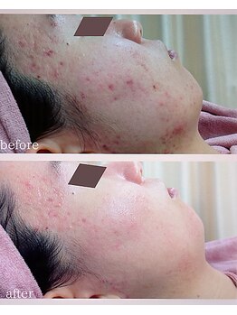 クリニカルエステクリア 梅田店/【ニキビケア×凸凹毛穴改善】