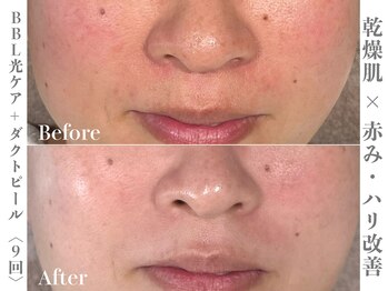 ゼアー(THERE FY.)/BBL×ダクトピール