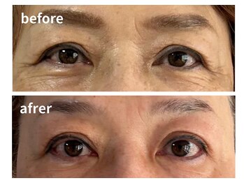 ウィッシュプロサロンケー(WISHpro salon K)/目元のしわ