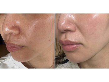 ソウ(Sow.)の写真/話題の水分爆弾とハーブピーリングで内側から潤う素肌へ◎