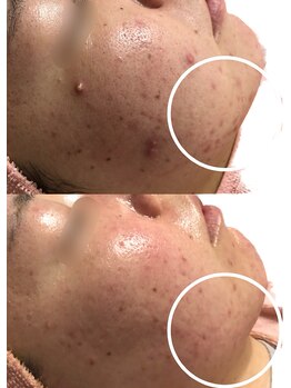 ベストベル(BestBelle)/肌質改善できるハーブピーリング