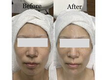 エステサロン ソワン/小顔矯正　BeforeAfter