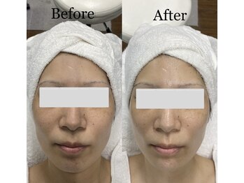 エステサロン ソワン/小顔矯正　BeforeAfter