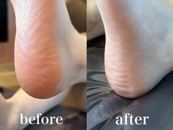 ドクターネイル爪革命 札幌本店/症例紹介27 角質ケア