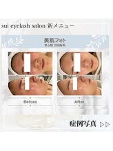 スイ(Sui)/美肌光フォトbefore after