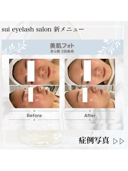 スイ(Sui)/美肌光フォトbefore after