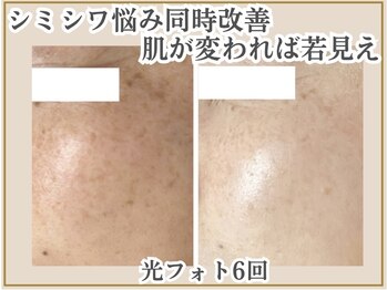 ポモナ 横浜馬車道店(Pomona)の写真/[本気でシミゼロ美肌ケア]個数制限なし!全顔シミケア8800円!たるみやしわも同時にケア!若々しい見た目に★