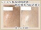 ポモナ 横浜馬車道店(Pomona)の写真/[本気でシミゼロ美肌ケア]個数制限なし!全顔シミケア8800円!たるみやしわも同時にケア!若々しい見た目に★
