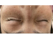 ピュアージュ/ハーブピーリング