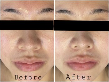 レイズ(RAISE)/顔脱毛×毛穴洗浄